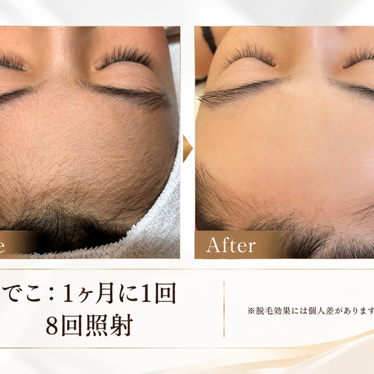 おでこ脱毛ビフォーアフター比較