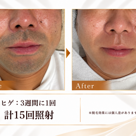 ヒゲ脱毛のビフォーアフター 恒一