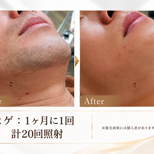 ヒゲ脱毛のビフォーアフター比較