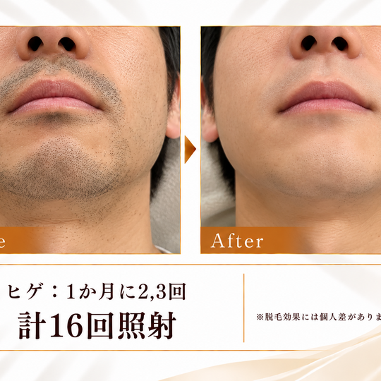 ヒゲ脱毛ビフォーアフター広告