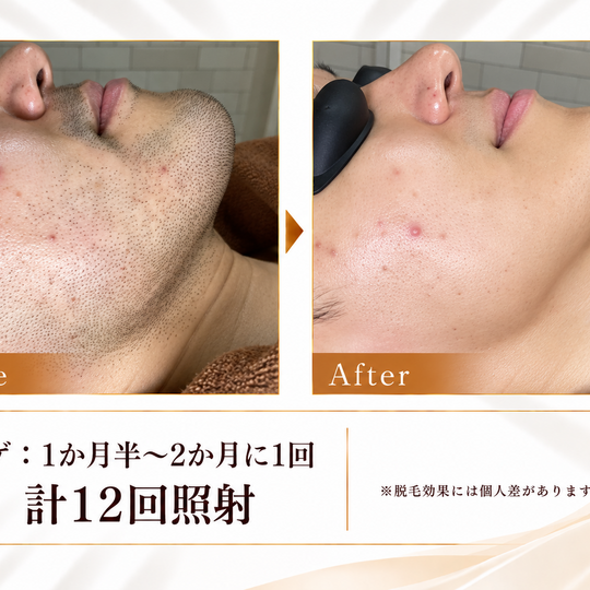 ヒゲ脱毛ビフォーアフター症例 сәв