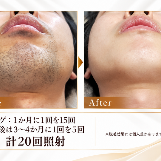 ヒゲ脱毛ビフォーアフター比較 (1)