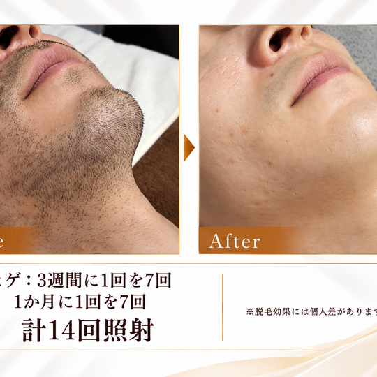 ヒゲ脱毛ビフォーアフター比較 (3)