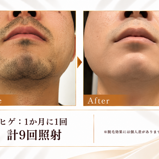ヒゲ脱毛ビフォーアフター比較