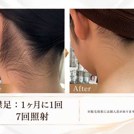 襟足脱毛ビフォーアフター比較