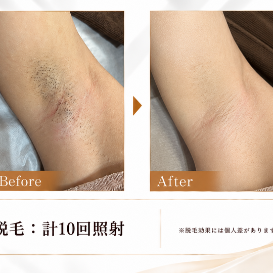 脱毛ビフォーアフター広告