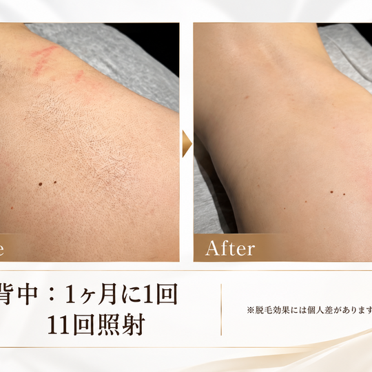 背中脱毛ビフォーアフター比較