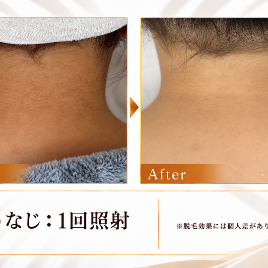 うなじ脱毛ビフォーアフター-10