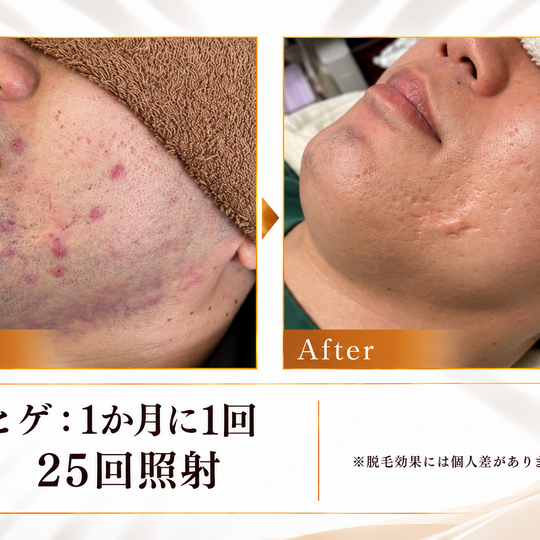 ヒゲ脱毛25回のビフォーアフター-11