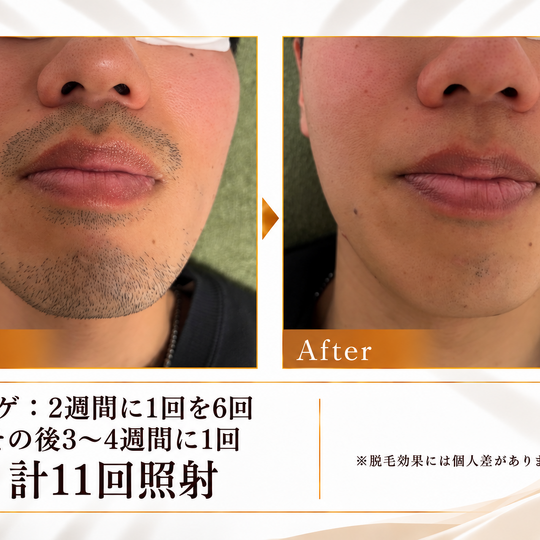 ヒゲ脱毛のビフォーアフター
