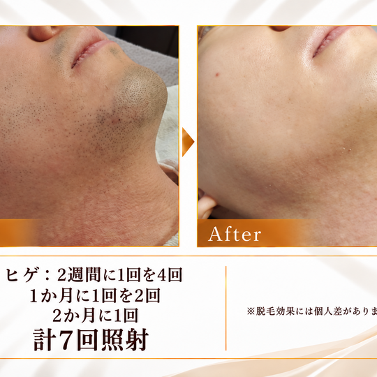 ヒゲ脱毛のビフォーアフター-5