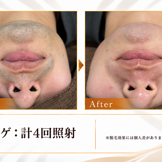 ヒゲ脱毛のビフォーアフター-7