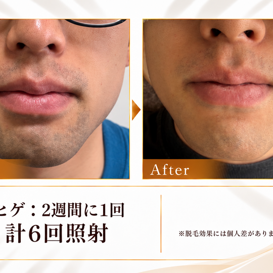 ヒゲ脱毛のビフォーアフター-10