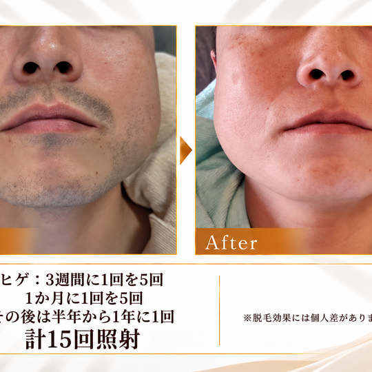 ヒゲ脱毛のビフォーアフター案内