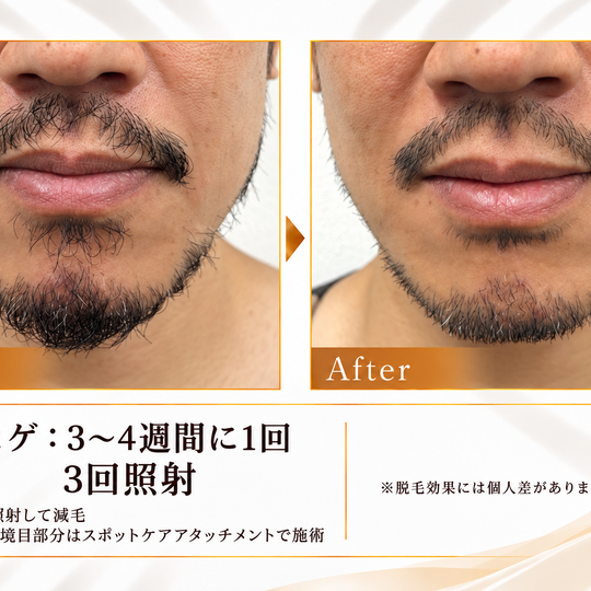ヒゲ脱毛のビフォーアフター結果カード-6