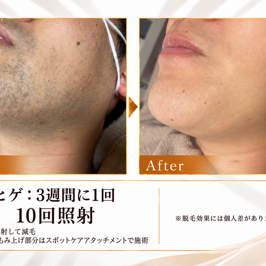 ヒゲ脱毛のビフォーアフター比較