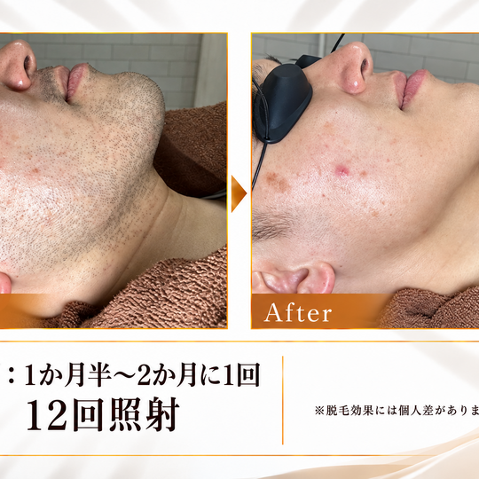 ヒゲ脱毛ビフォーアフター (1)