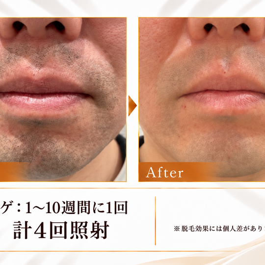 ヒゲ脱毛ビフォーアフター