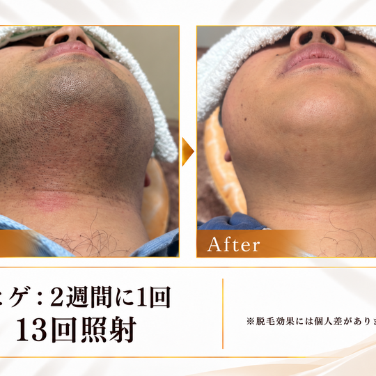 ヒゲ脱毛ビフォーアフター-1