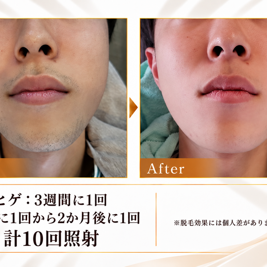 ヒゲ脱毛ビフォーアフター-3