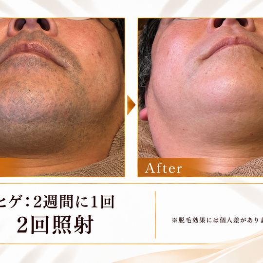 ヒゲ脱毛ビフォーアフター-5