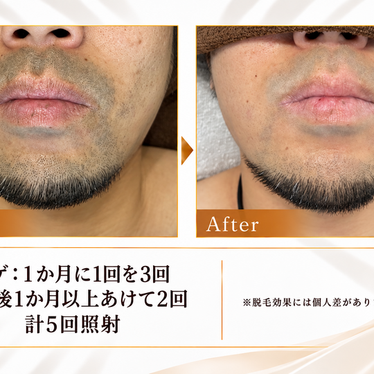 ヒゲ脱毛ビフォーアフター-7