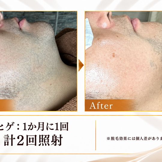 ヒゲ脱毛ビフォーアフター-10
