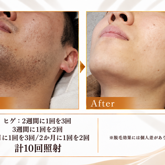 ヒゲ脱毛ビフォーアフター結果-9