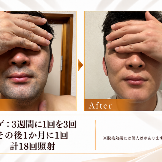 ヒゲ脱毛ビフォーアフター結果カード-2