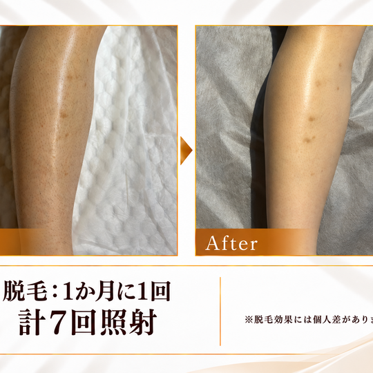 脚の脱毛ビフォーアフター-7
