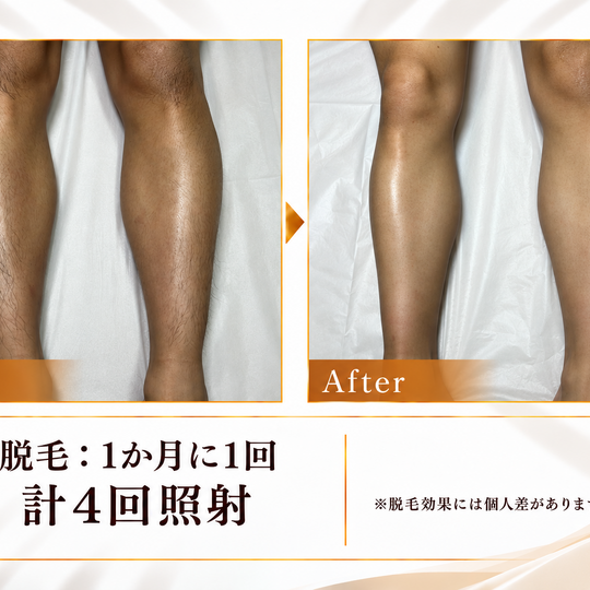 脚脱毛4回のビフォーアフター-5