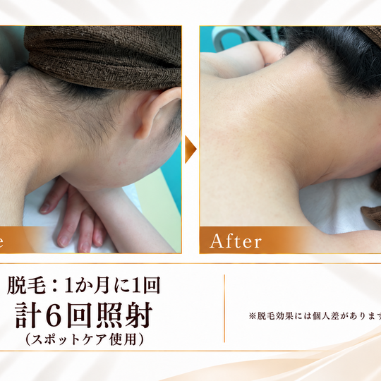 襟足脱毛のビフォーアフター