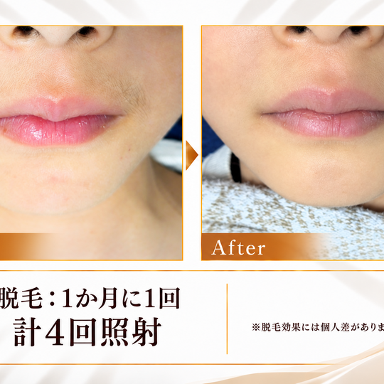 口まわり脱毛のビフォーアフター-9