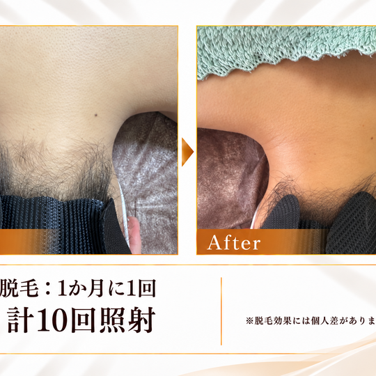 首元の脱毛ビフォーアフター-12