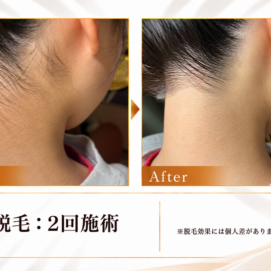 首元脱毛ビフォーアフター-9