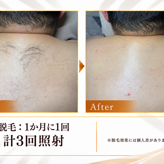 上背部脱毛のビフォーアフター-6