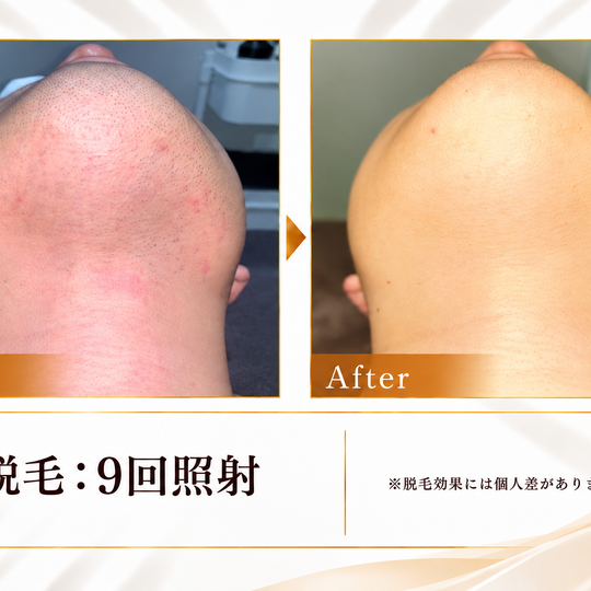 脱毛9回のビフォーアフター-1