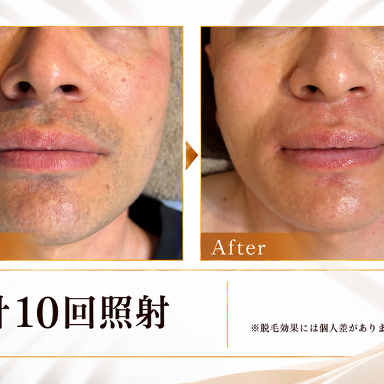 脱毛10回のビフォーアフター-3