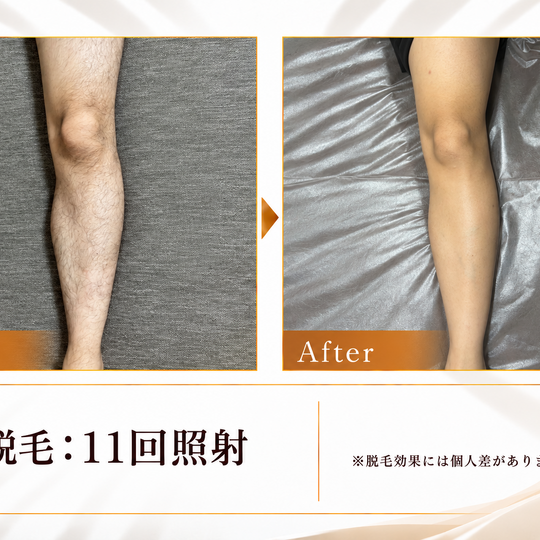 脱毛11回照射のビフォーアフター-11