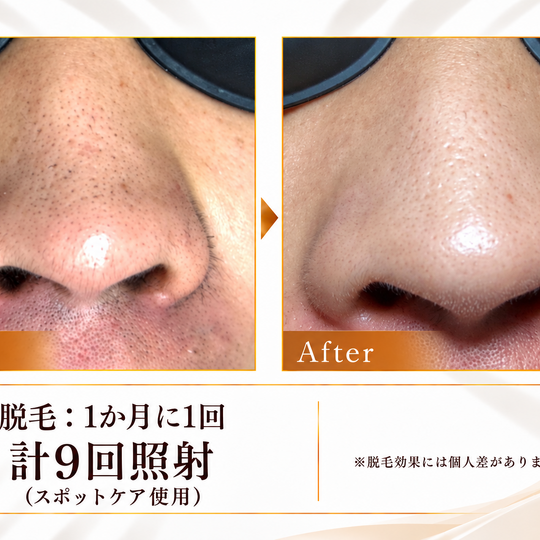 脱毛のビフォーアフター比較