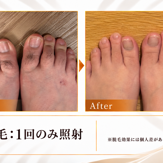 脱毛施術のビフォーアフター-1