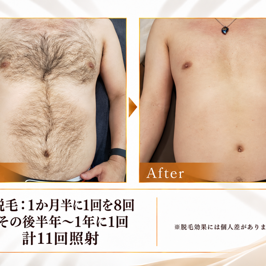 脱毛施術のビフォーアフター比較-5