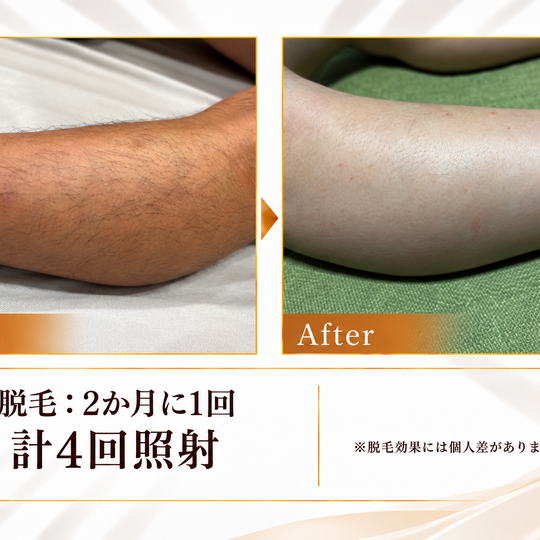 脱毛施術ビフォーアフター-6