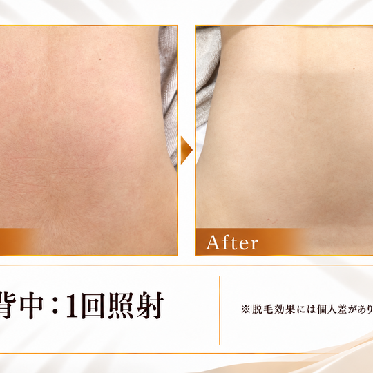 背中脱毛のビフォーアフター-8