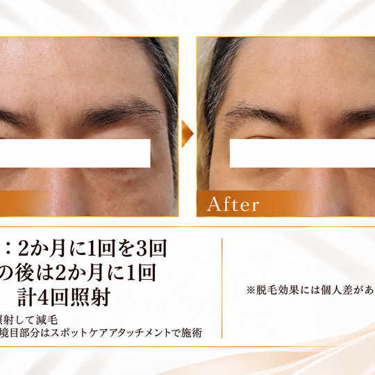 眉周り脱毛のビフォーアフター-11