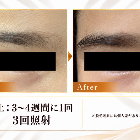 眉上脱毛のビフォーアフター-5