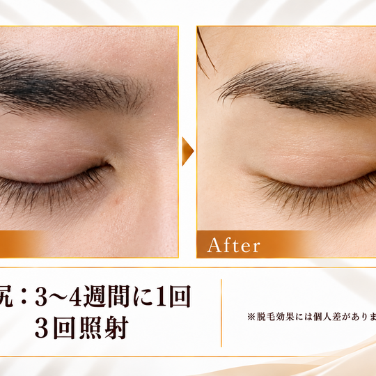 眉尻脱毛のビフォーアフター-3