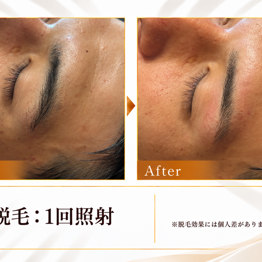 眉毛脱毛のビフォーアフター-9