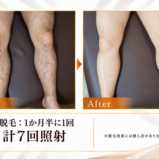 両脚の脱毛ビフォーアフター-5