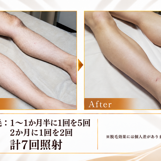 両脚脱毛のビフォーアフター-3